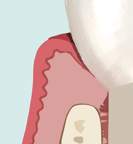 Diente natural — referencia