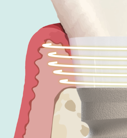 Cuello de zirconio — biomimético