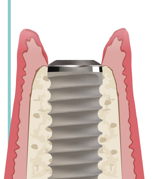 Categoría 1 — implante de titanio bone level