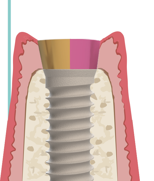 Categoría 3 — implante de titanio tissue level con cuello tratado