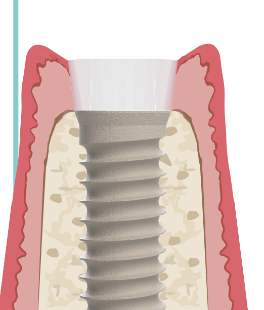 Categoría 4 — implante de titanio tissue level con cuello de zirconio