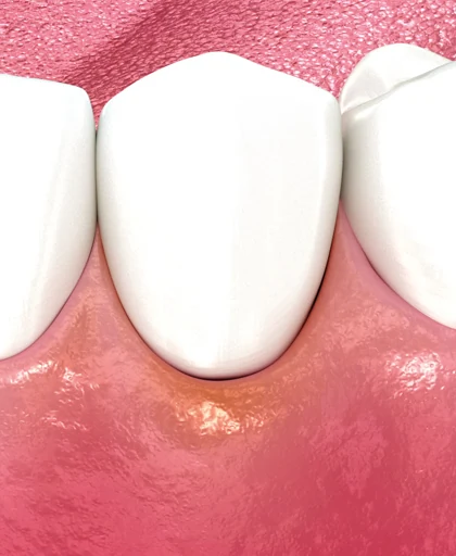 Mucositis