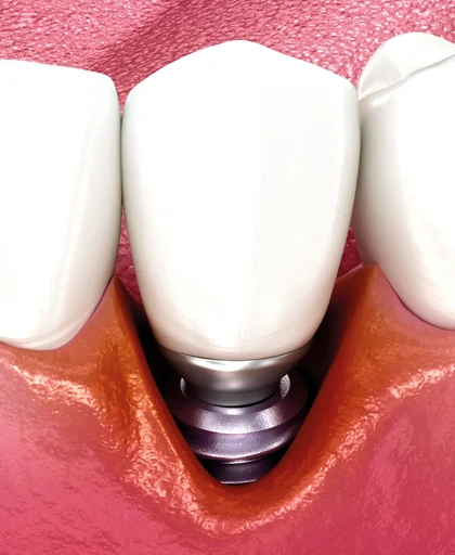 Periimplantitis