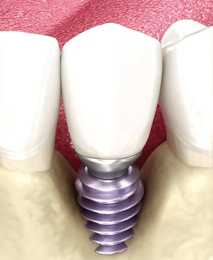 Pérdida de osteointegración