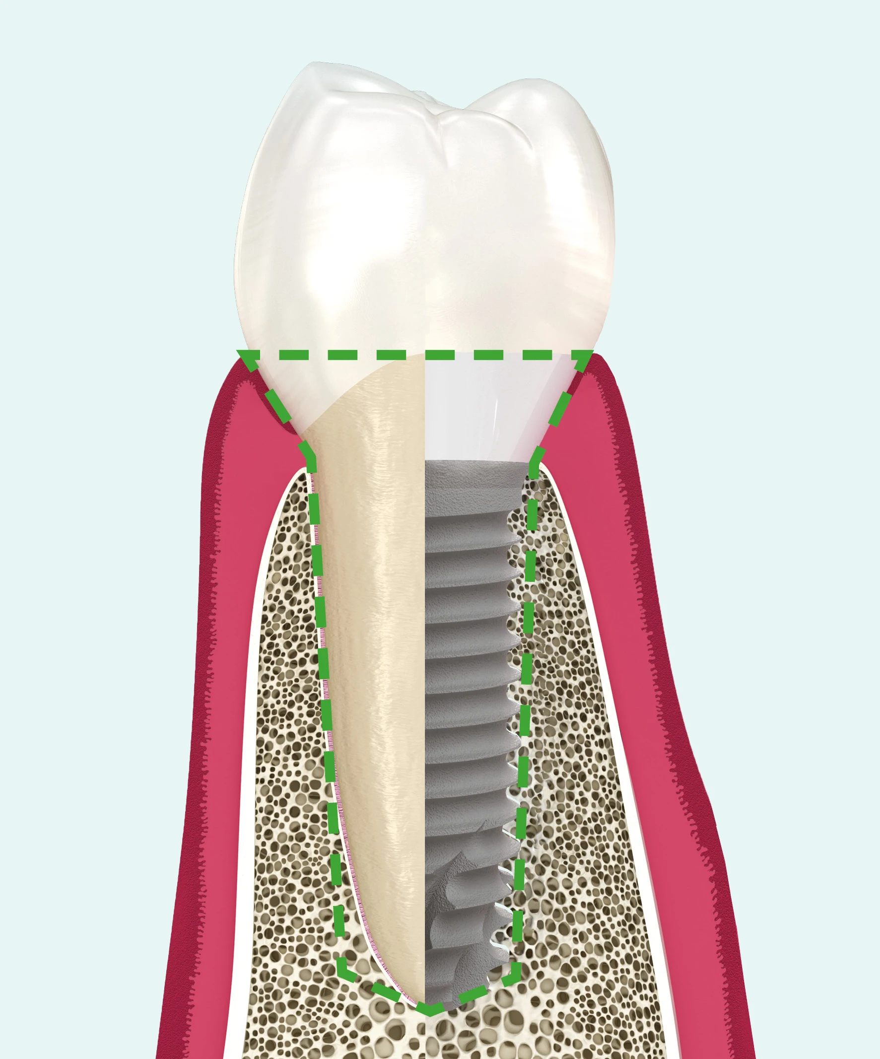 Perfil de emergencia biomimético del cuello Z1