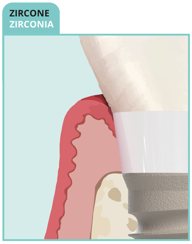 Cuello de zirconio Z1 — translucidez biomimética